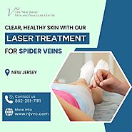 Laser Treatment for Spider Veins in NJ