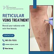 Reticular Veins Treatment in NJ