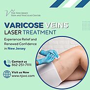 Varicose Veins Laser Treatment in NJ