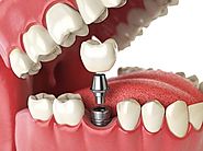 Dental Implant Services at Facets Dental Clinic Kochi