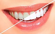 Teeth Whitening | Facets