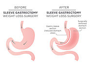 Mini Anastamosis Gastric Bypass | Gastric Bypass Surgery New Delhi,India