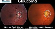 DRR Hospital Chennai: Find Out How Glaucoma Can Make You Happy