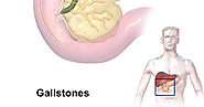 Topmost Best Gallstones Treatment Pune: The Best Gallstones Treatment in Pune, Maharashtra