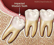 A Few Things You Need to Know Before Going For Wisdom Teeth Removal