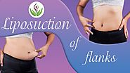 Liposuction of flanks