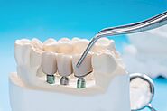Vital Factors that Identify your Eligibility for Dental Implant - Every Day Blogs