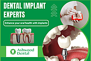 Permanent Dental Implant Restoration Services