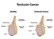 Testicular Cancer Symptoms, Causes and Treatments in Chennai | Tamil Nadu