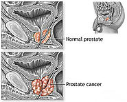 Prostate Cancer Signs,Symptoms and Treatment Chennai | Tamil Nadu