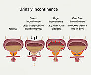 Urinary Incontinence Treatment Chennai | Involuntary Urination Treatment India