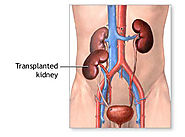 Kidney Disease Treatments India | Renal Failure Transplantation