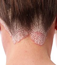 Signs And Symptoms Of Psoriasis