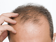 How to Stop Hair fall - Natural Home remedies to try at Home