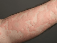 Effective ways to get rid of Urticaria/Hives and its Causes