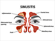 Sinusitis and polyps