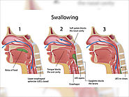 Swallowing disorders | Dysphagia Treatment in Bangalore