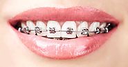 Understanding The Concept Of Dentures Penrith And Braces Penrith Services.