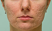 Why do acne scars form?