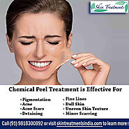 Cost of Chemical Peels for Pigmentation Treatment in South West Delhi