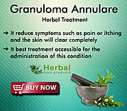 Best Way to Treat Granuloma Annulare Naturally at Home – Herbal Care Products