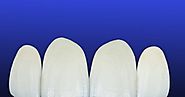 5 Things to consider when using porcelain veneers to fabricate a perfect smile!