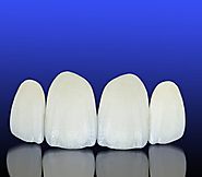 Porcelain veneers Melbourne professionals can deal with many dental issues