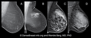 Dense Breast Tissue, Dense Breasts | DenseBreast-info