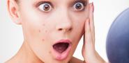 Various Easy Treatments For Acne And Pimples