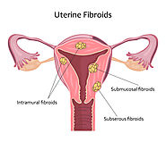 Website at https://www.fertility-clinic.in/fibroid-removal-myomectomylaparoscopic-myomectomy