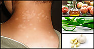 Tinea Versicolor Home Remedies and Natural Treatment - Herbal Care Products