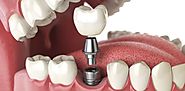 Why should you get dental implants?