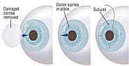 Corneal Transplant in Delhi | Best Eye Care Center India