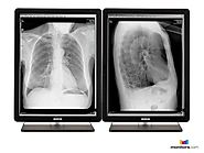 Refurbished Barco Coronis 3MP Pair Radiology Monitors - MDCG-3221