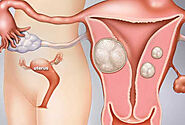 Visualizing Fibroids in Uterus: Your Essential Guide