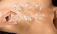 Cupping Therapy in San Francisco | Anchor Acupuncture & Wellness