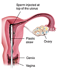 Website at https://www.arcivf.com/treatments/intrauterine-insemination