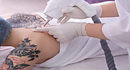 Tattoo Removal Cost in The USA [2021]- Ultimate Guide