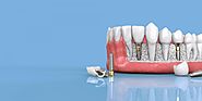 Things you might not be aware about dental implants