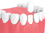 Everything you need to know about Dental Crowns