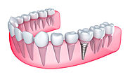 Get a permanent solution for your teeth: Dental Implants