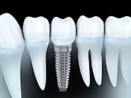 How to find the best dental implant dentist?
