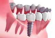 A dental implant- a go-through way to improve the overall health
