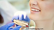 A list of common misconceptions about dental implants