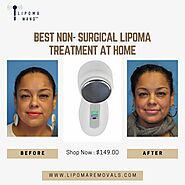 Get the Best Non- Surgical Lipoma Treatment at Home