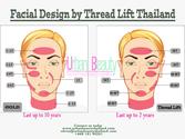 Gold Thread Stem Cell Facelift Bangkok Thailand-Urban Beauty Thailand