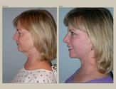 Facelift and Necklift Surgery Thailand - Urban Beauty Thailand
