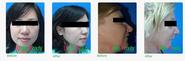 Get Gorgeous Now with Facial Liposuction - Urban Beauty Thailand