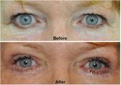 Upper Eyelid Fat Surgery in Thailand. Blepharoplasty