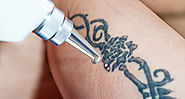 Laser Tattoo Removal: Aftercare Instructions - Trending Tattoo